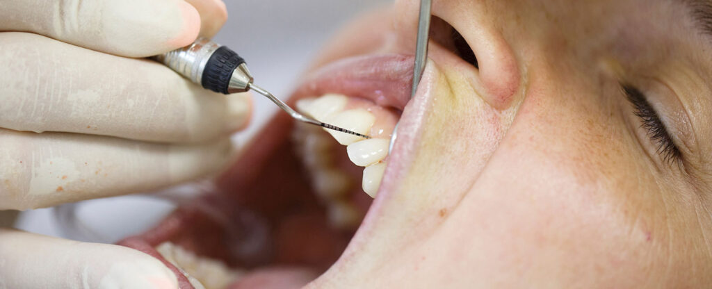 Patientin mit weit geöffnetem Mund wird mit Sonde und Spiegel untersucht